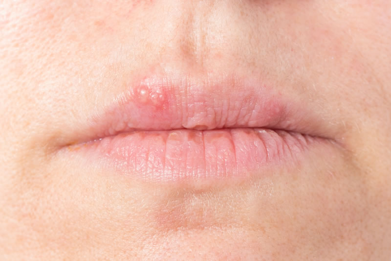 画像：口唇ヘルペス・帯状疱疹